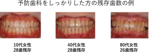 予防歯科をしっかりした方の残存歯数の例